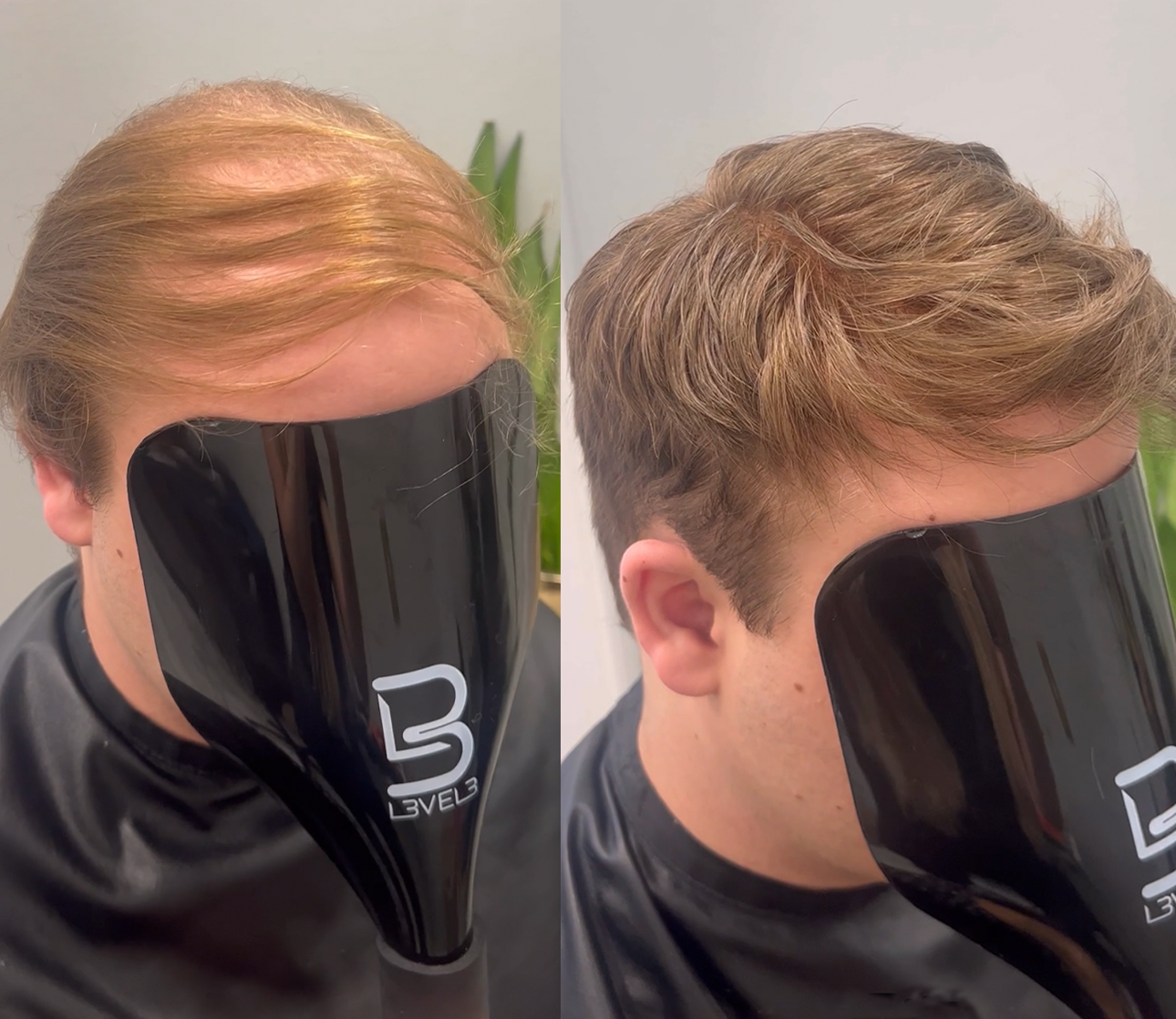 Men's hair system transformation Men's hair system transformation from thinning hair to a curly style