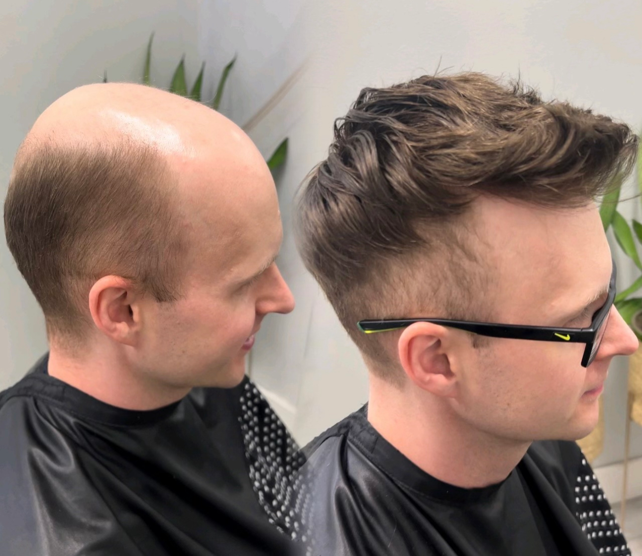 Men's hair replacement result Before-and-after men's hair replacement result with a dark styled hair system