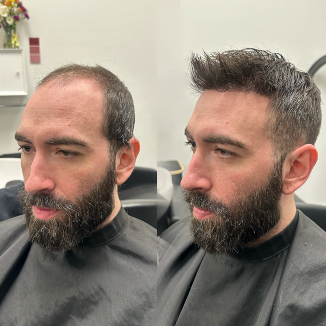 Bearded client hair system result Before-and-after hair system result for a bearded client