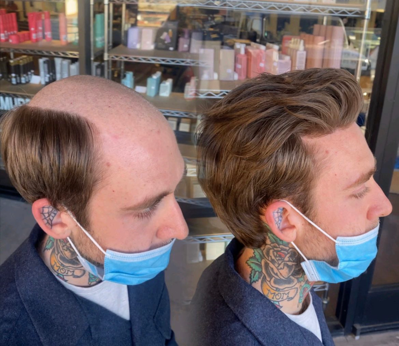 Men's hair system consultation result Men's hair system before-and-after result for a consultation