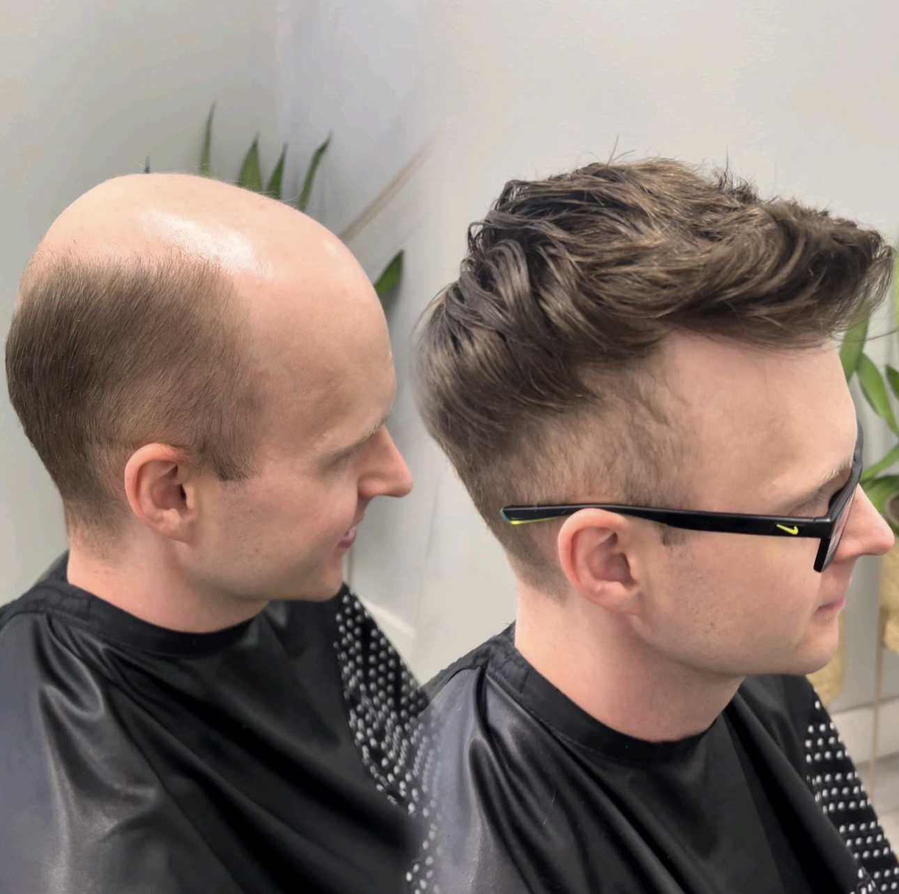Custom men's hair system result Before-and-after custom men's hair system result